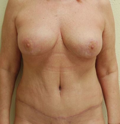 Mommy Makeover Case 25 - After