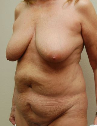 Mommy Makeover: Case 25 - Before