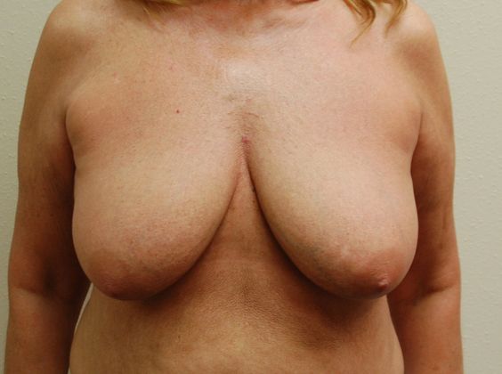 Breast Lift (Mastopexy) Case 10 - Before