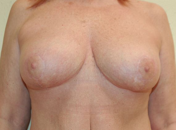 Breast Lift (Mastopexy) Case 10 - After