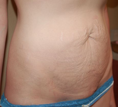 Massive Weight Loss : Case 13 - Before