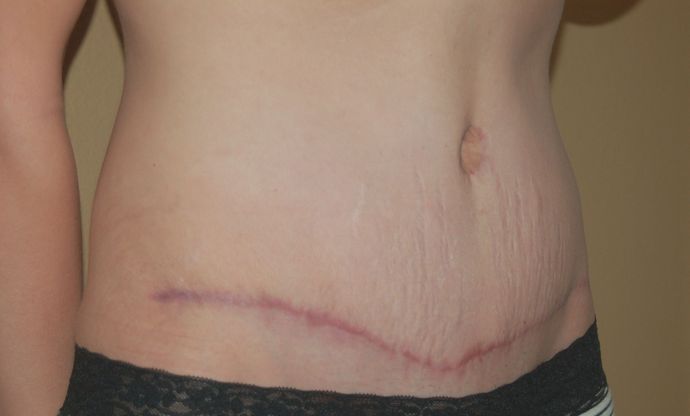 Massive Weight Loss : Case 13 - After