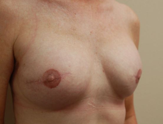 Breast Reconstruction: Case 25 - After