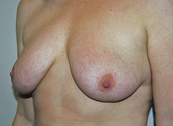 Breast Augmentation w/ Lift: Case 58 - Before