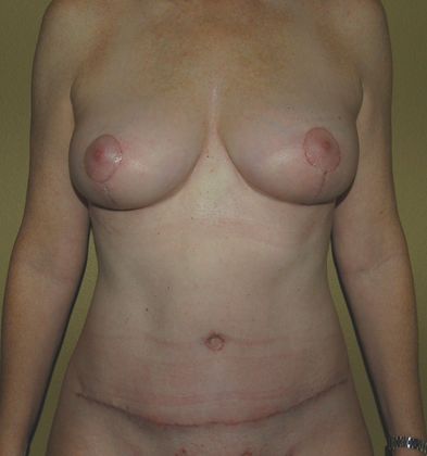 Mommy Makeover Case 26 - After