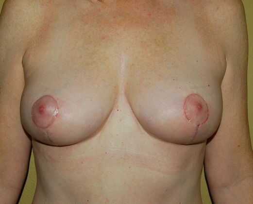 Breast Lift (Mastopexy) Case 11 - After