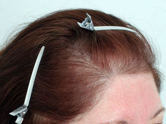 Hair Transplant - Female: Frontal FUT - Before female hair transplant