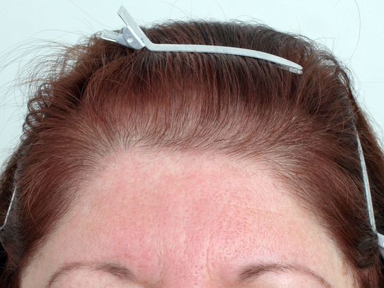 Hair Transplant - Female: Frontal FUT - Before female hair transplant