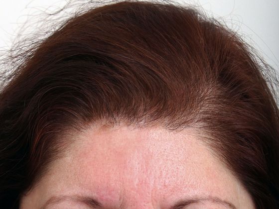 Hair Transplant - Female: Frontal FUT - After female hair transplant