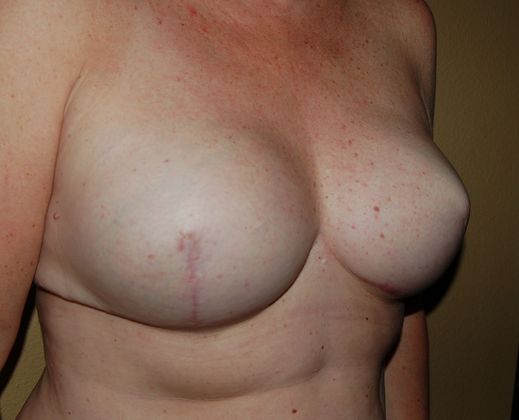 Breast Reconstruction: Case 26 - After