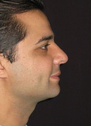 Rhinoplasty: Case 1 - after 3 months