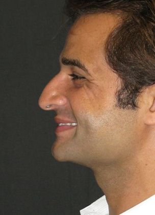 Rhinoplasty: Case 1 - before, plunging tip