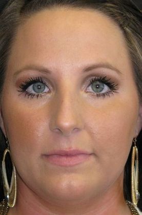 Rhinoplasty Case 2 - Before