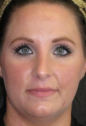 Rhinoplasty Case 2 - After