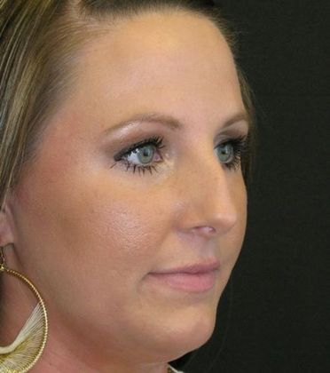 Rhinoplasty: Case 2 - before