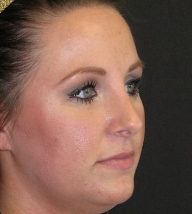 Rhinoplasty: Case 2 - after 16 months