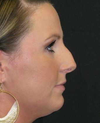 Rhinoplasty: Case 2 - before
