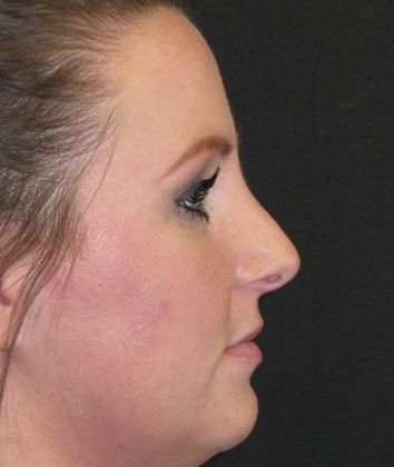 Rhinoplasty: Case 2 - after 16 months