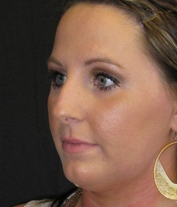 Rhinoplasty: Case 2 - before