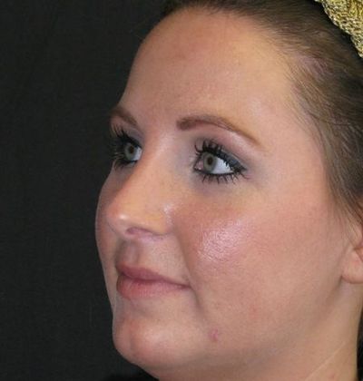 Rhinoplasty: Case 2 - after 16 months