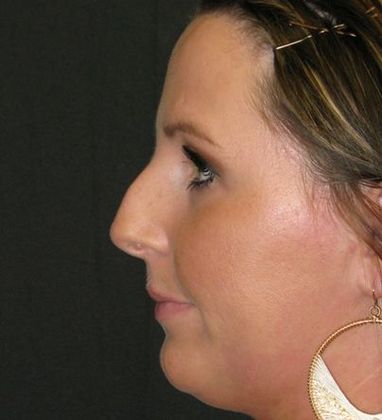 Rhinoplasty: Case 2 - before