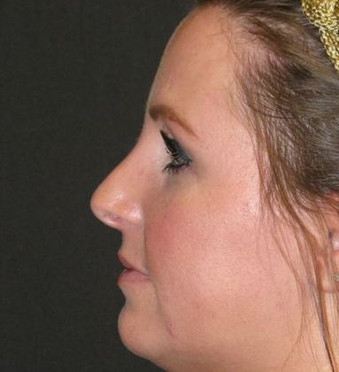 Rhinoplasty: Case 2 - after 16 months