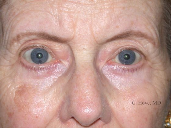 Eyelids (Blepharoplasty) Case 7- Lower Eyelid Blepharoplasty (Dr Christopher Hove, Philadelphia