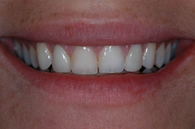 Porcelain Veneers Case 1 - After