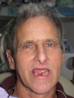 Full Mouth Implants Raymond’s Full Mouth Implants After Years Without Teeth - Before