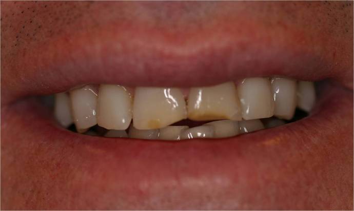Cosmetic Bonding: Case 3 - Before