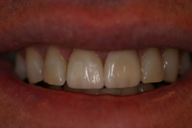 Cosmetic Bonding: Case 3 - After