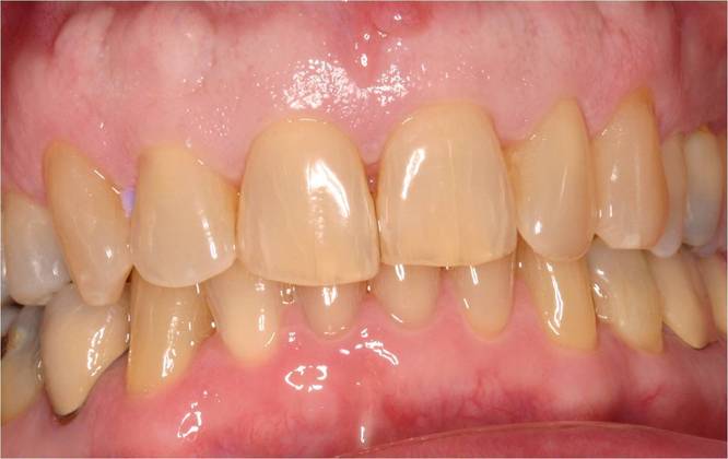 Veneers Case 1 - Before