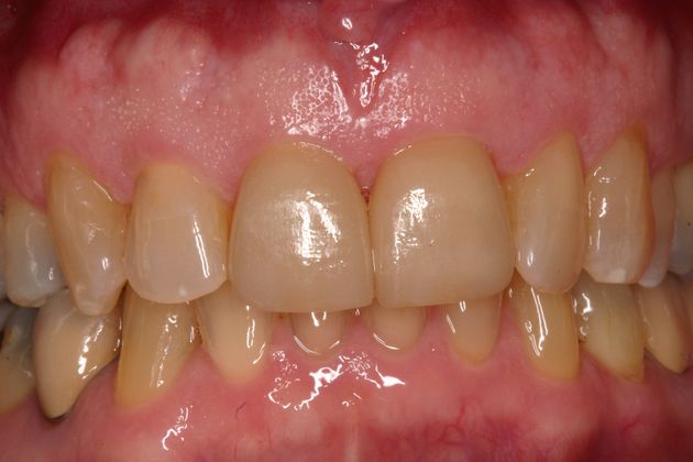 Veneers Case 1 - After