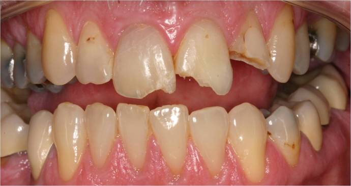 Veneers Case 2 - Before