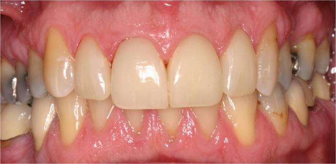 Veneers Case 2 - After