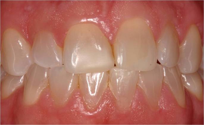 Veneers Case 3 - Before