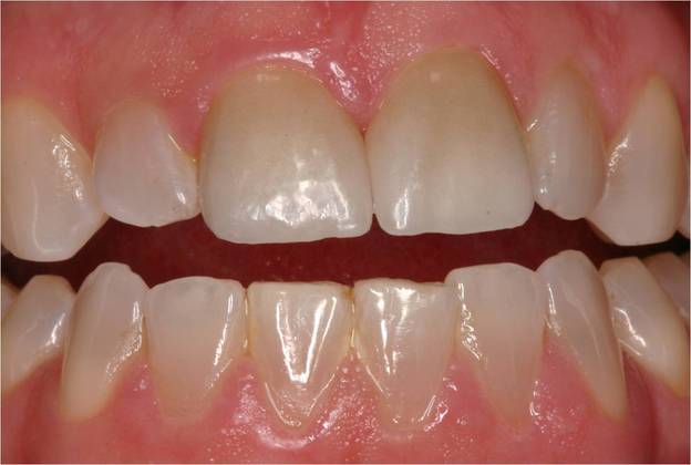 Veneers Case 3 - After
