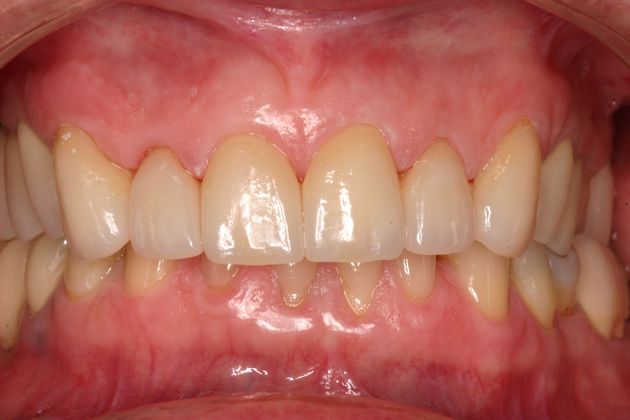Veneers Case 5 - After
